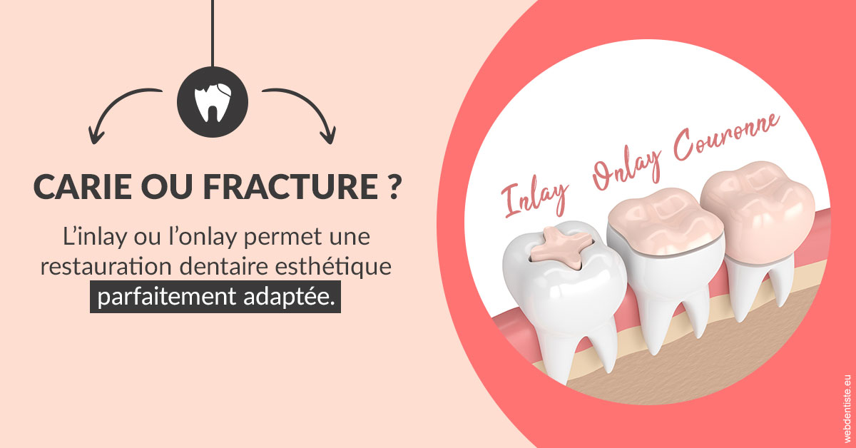 https://selarl-dr-simine-hassaneyn.chirurgiens-dentistes.fr/T2 2023 - Carie ou fracture 2