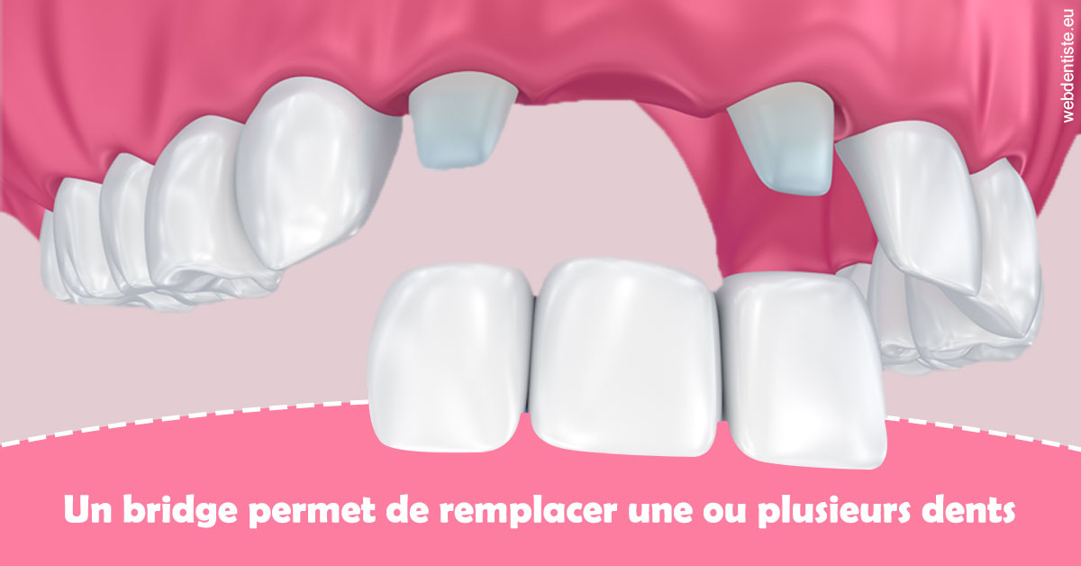 https://selarl-dr-simine-hassaneyn.chirurgiens-dentistes.fr/Bridge remplacer dents 2