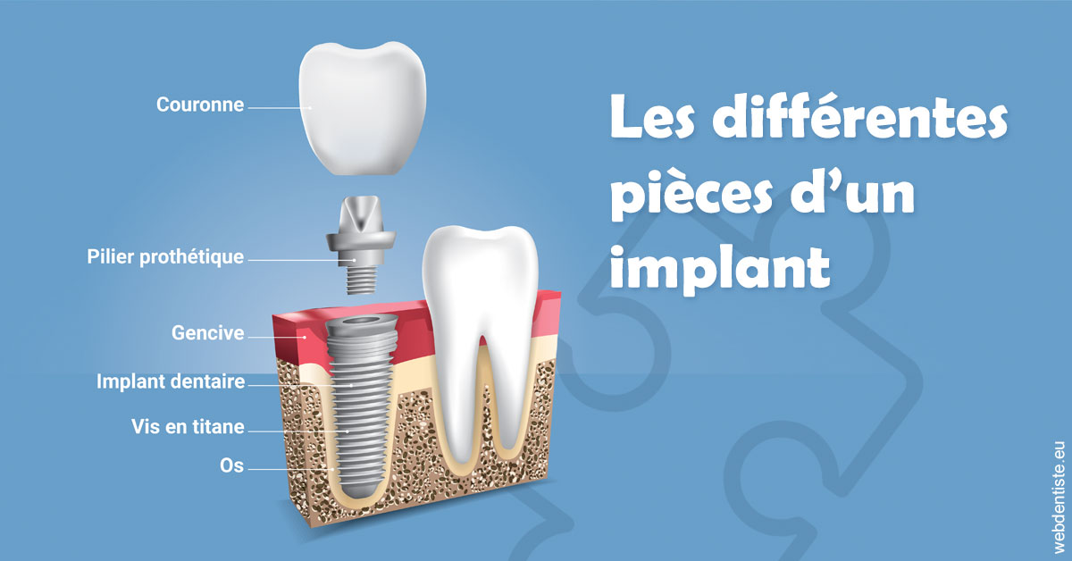 https://selarl-dr-simine-hassaneyn.chirurgiens-dentistes.fr/Les différentes pièces d’un implant 1